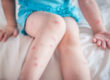 Red swollen Mosquito bites on a kid's legs and arms