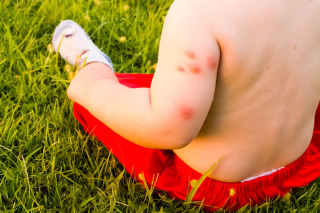 New,Born,With,Multiple,Mosquito,Bites,Allergy,To,Insect,Bites